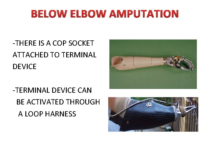 BELOW ELBOW AMPUTATION -THERE IS A COP SOCKET ATTACHED TO TERMINAL DEVICE -TERMINAL DEVICE