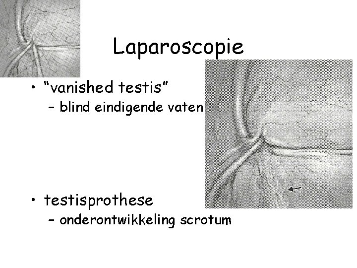 Laparoscopie • “vanished testis” – blind eindigende vaten • testisprothese – onderontwikkeling scrotum 
