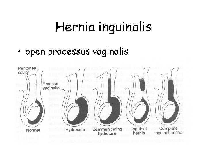 Hernia inguinalis • open processus vaginalis 