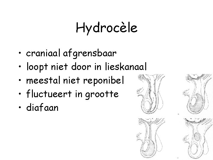 Hydrocèle • • • craniaal afgrensbaar loopt niet door in lieskanaal meestal niet reponibel
