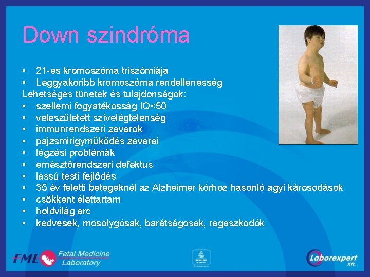 Down szindróma • 21 -es kromoszóma triszómiája • Leggyakoribb kromoszóma rendellenesség Lehetséges tünetek és