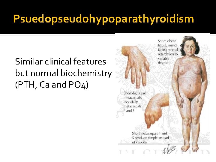 Psuedopseudohypoparathyroidism Similar clinical features but normal biochemistry (PTH, Ca and PO 4) 