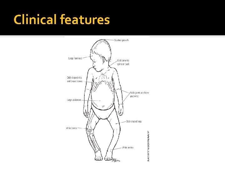 Clinical features 