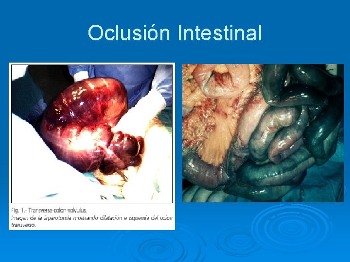 Oclusión Intestinal 