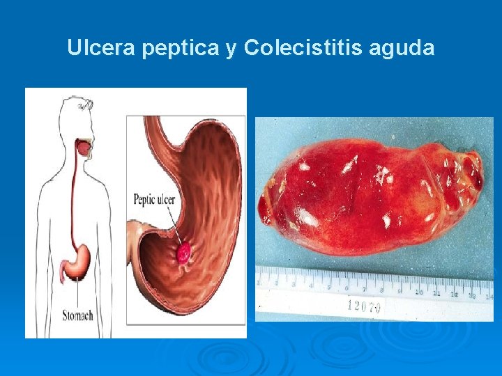 Ulcera peptica y Colecistitis aguda 