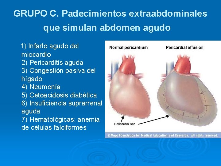 GRUPO C. Padecimientos extraabdominales que simulan abdomen agudo 1) Infarto agudo del miocardio 2)