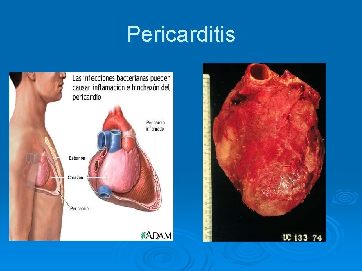 Pericarditis 