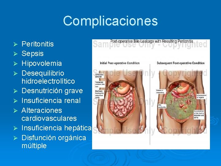 Complicaciones Ø Ø Ø Ø Ø Peritonitis Sepsis Hipovolemia Desequilibrio hidroelectrolítico Desnutrición grave Insuficiencia