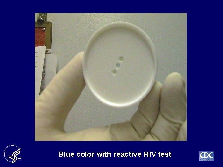 Blue color with reactive HIV test 