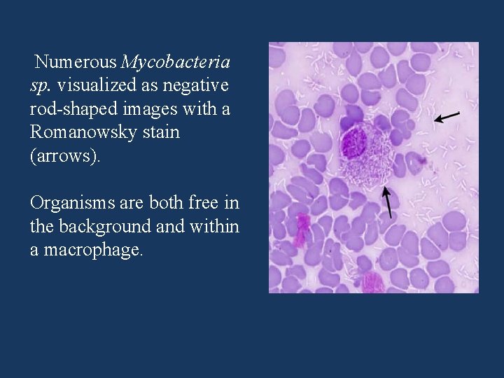 Numerous Mycobacteria sp. visualized as negative rod-shaped images with a Romanowsky stain (arrows). Organisms