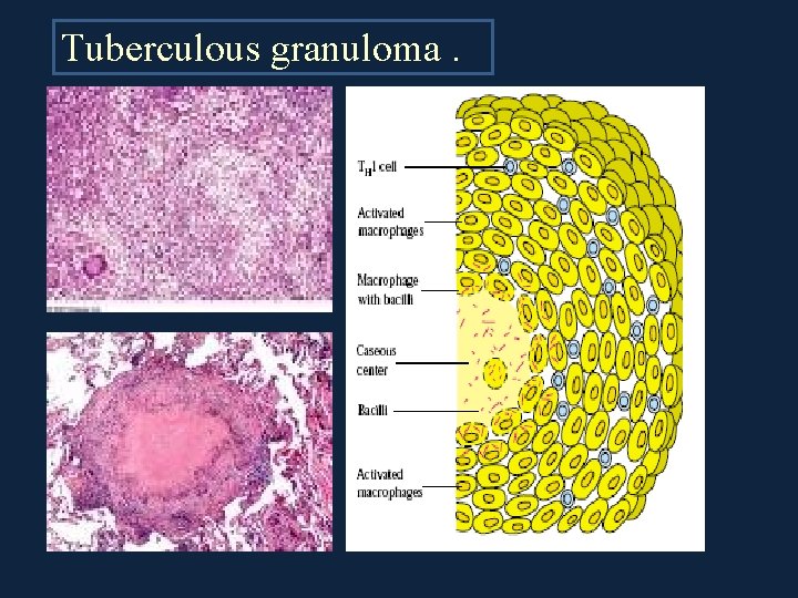 Tuberculous granuloma. 