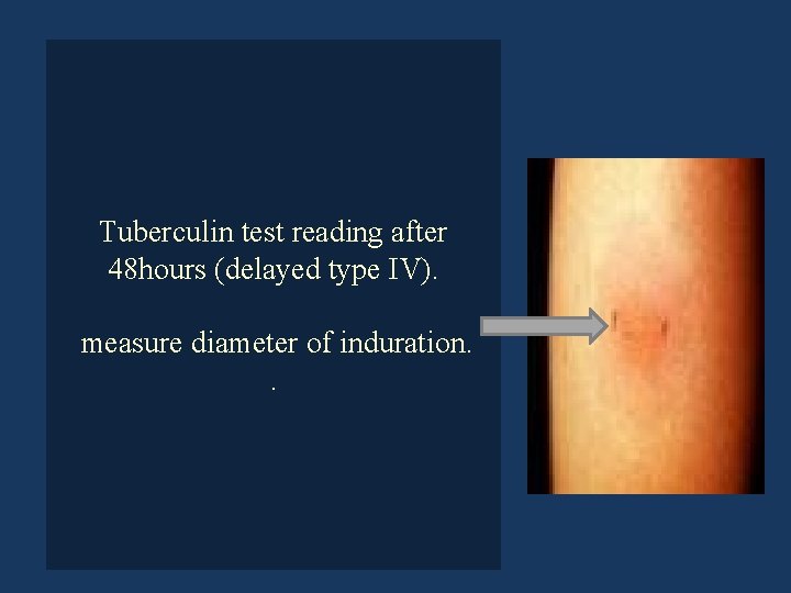 Tuberculin test reading after 48 hours (delayed type IV). measure diameter of induration. .