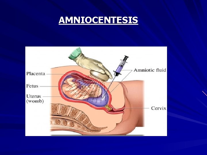 AMNIOCENTESIS 