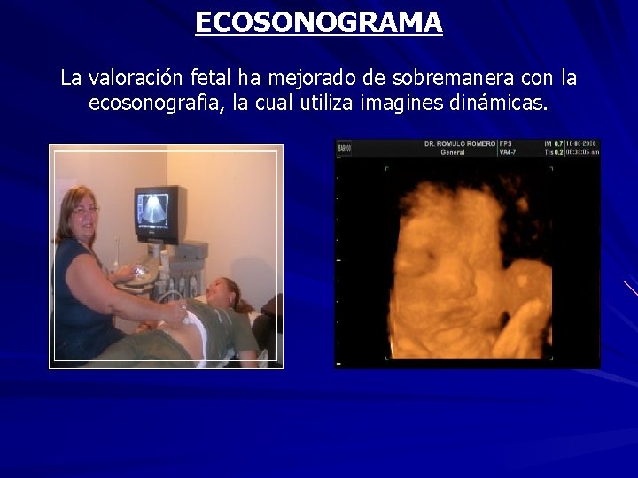 ECOSONOGRAMA La valoración fetal ha mejorado de sobremanera con la ecosonografia, la cual utiliza