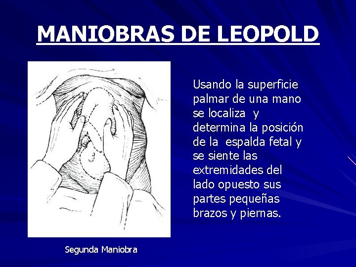 MANIOBRAS DE LEOPOLD Usando la superficie palmar de una mano se localiza y determina