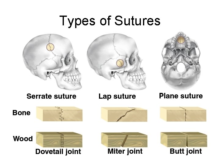 Types of Sutures 