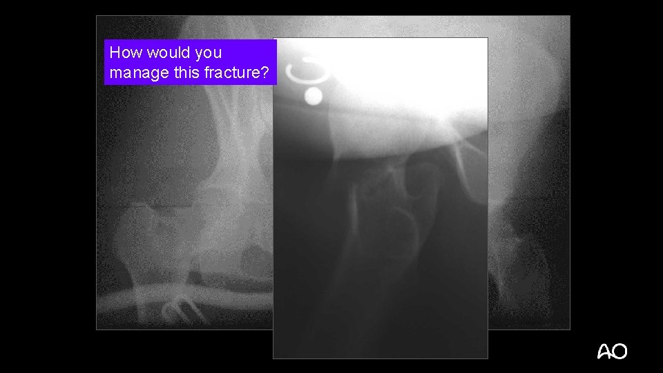 How would you manage this fracture? 