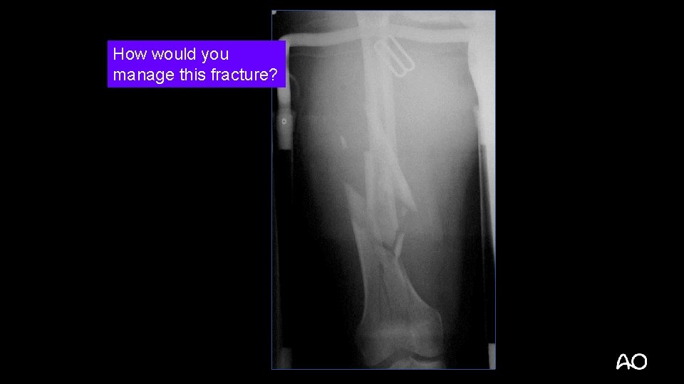How would you manage this fracture? 