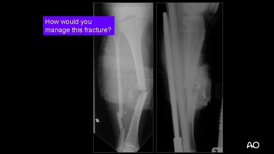 How would you manage this fracture? 