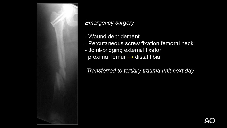 Emergency surgery - Wound debridement - Percutaneous screw fixation femoral neck - Joint-bridging external