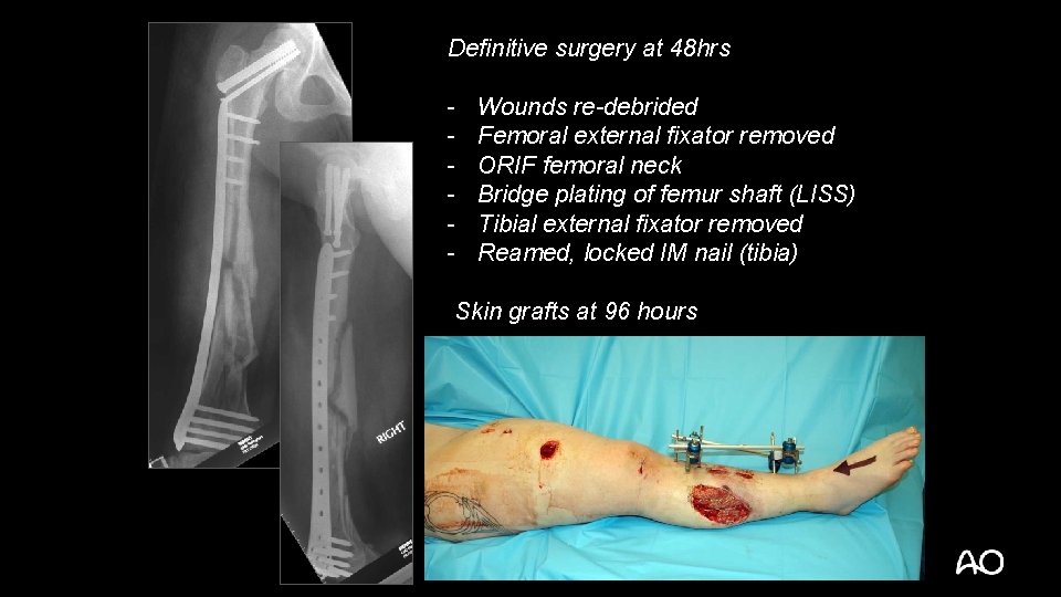 Definitive surgery at 48 hrs - Wounds re-debrided Femoral external fixator removed ORIF femoral