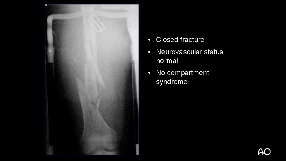  • Closed fracture • Neurovascular status normal • No compartment syndrome 