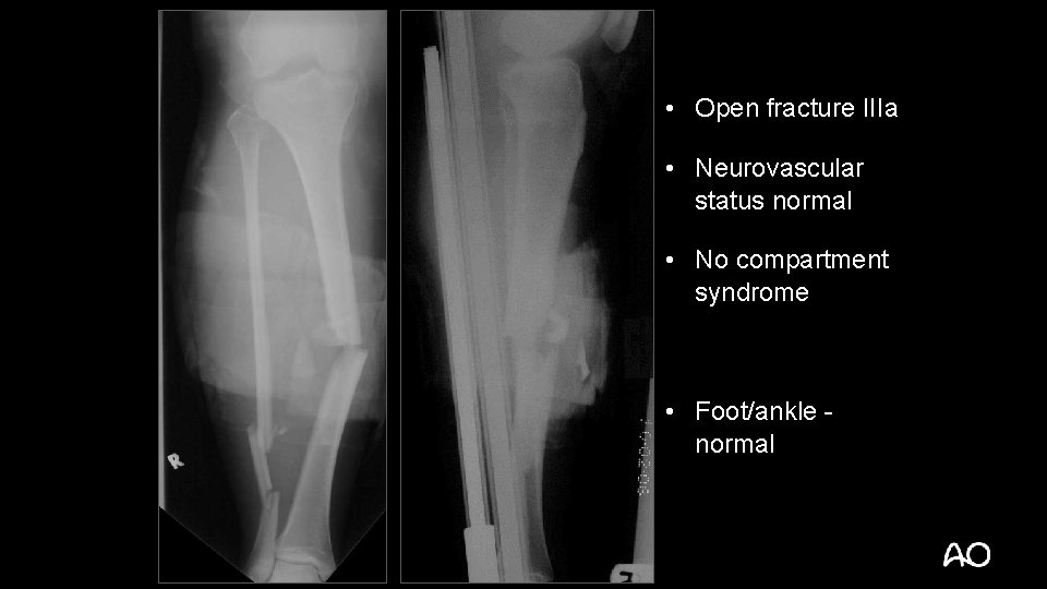  • Open fracture IIIa • Neurovascular status normal • No compartment syndrome •
