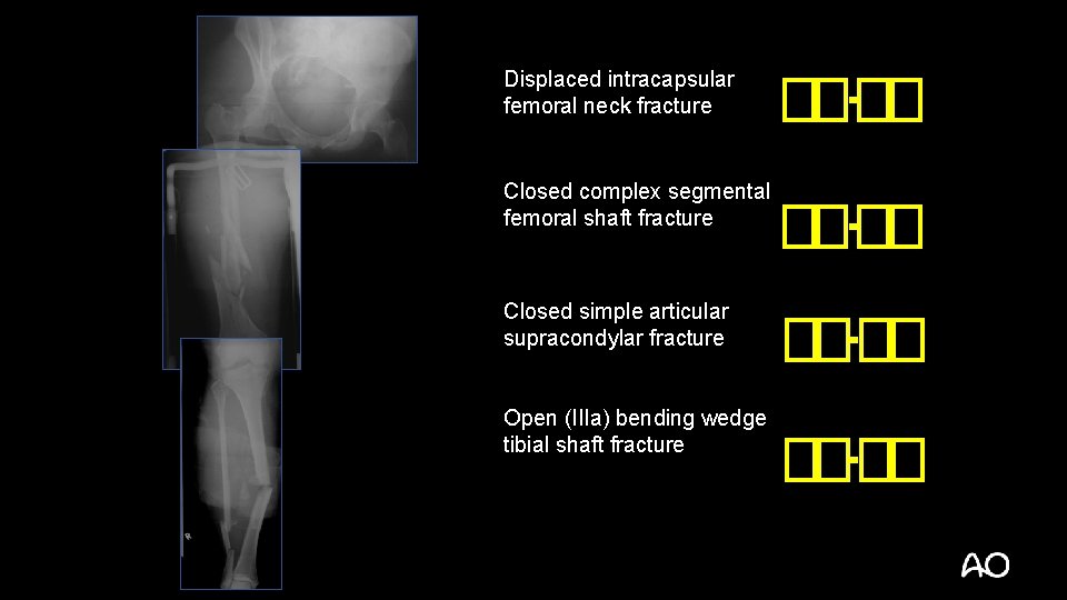 Displaced intracapsular femoral neck fracture Closed complex segmental femoral shaft fracture Closed simple articular