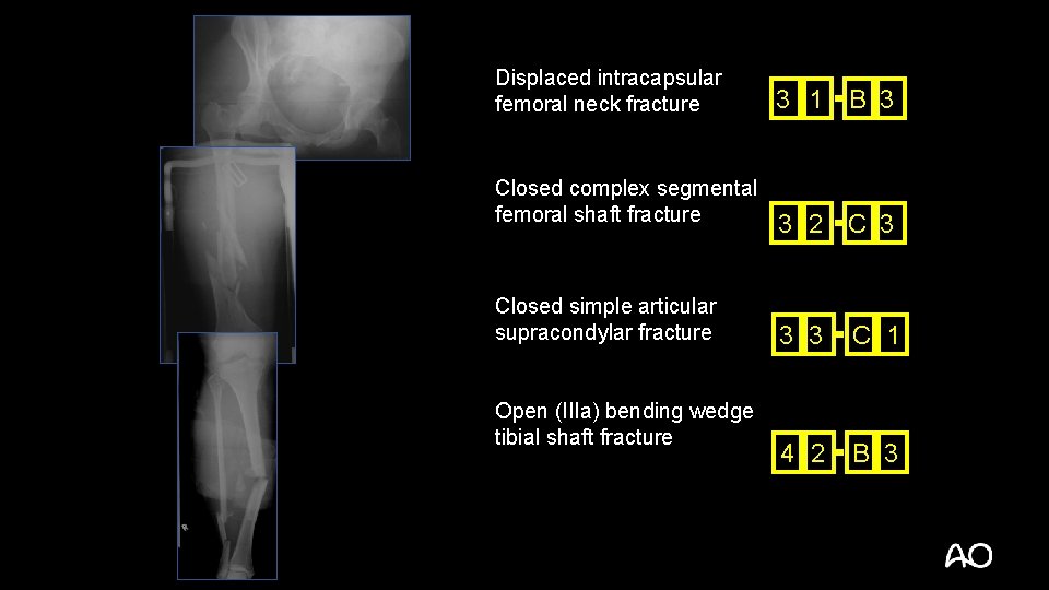 Displaced intracapsular femoral neck fracture Closed complex segmental femoral shaft fracture Closed simple articular