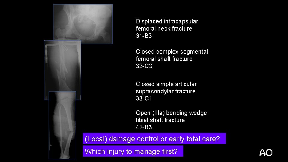 Displaced intracapsular femoral neck fracture 31 -B 3 Closed complex segmental femoral shaft fracture