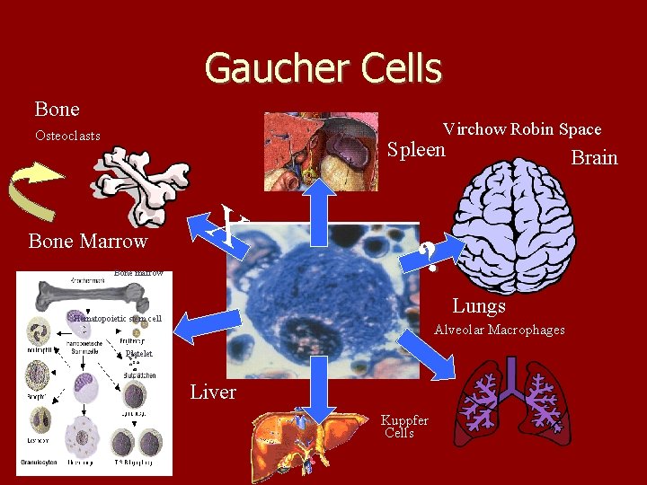 Gaucher Cells Bone Virchow Robin Space Osteoclasts Spleen Bone Marrow X Bone marrow Brain
