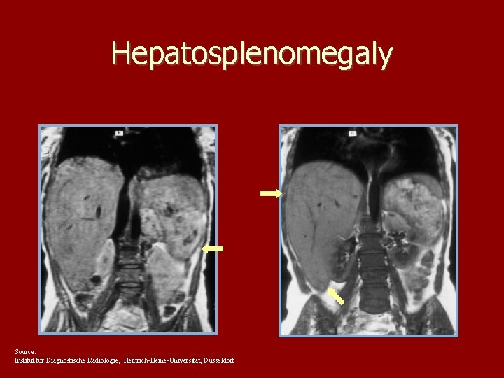 Hepatosplenomegaly Source: Institut für Diagnostische Radiologie, Heinrich-Heine-Universität, Düsseldorf 