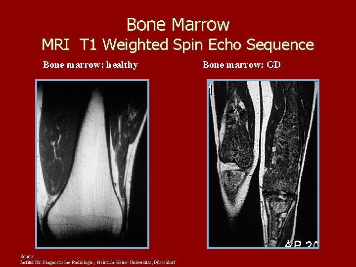 Bone Marrow MRI T 1 Weighted Spin Echo Sequence Bone marrow: healthy Source: Institut