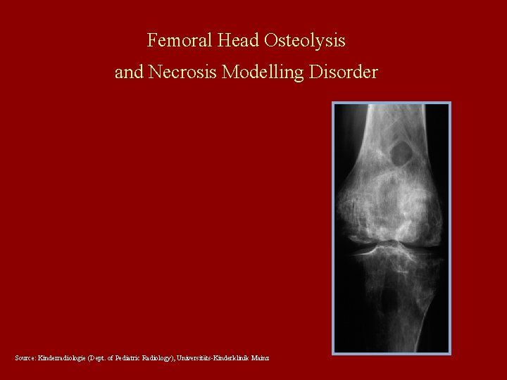 Femoral Head Osteolysis and Necrosis Modelling Disorder Source: Kinderradiologie (Dept. of Pediatric Radiology), Universitäts-Kinderklinik