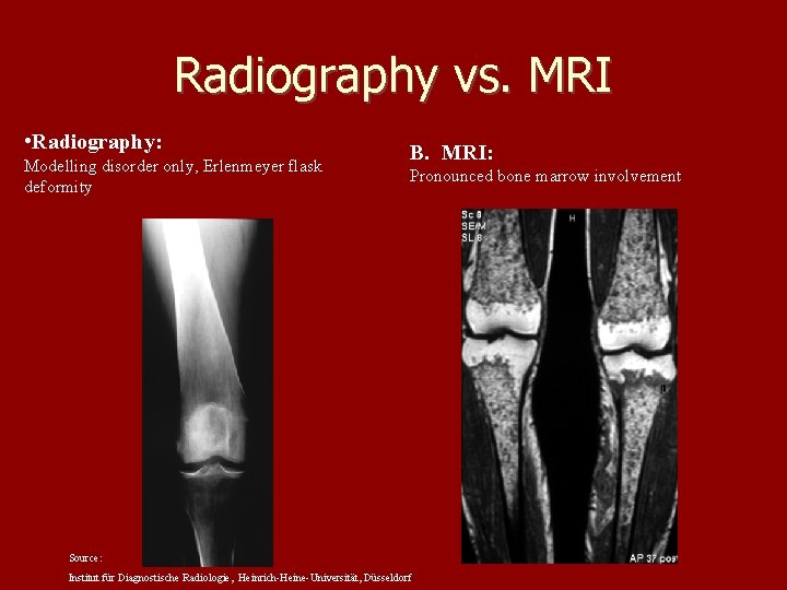 Radiography vs. MRI • Radiography: Modelling disorder only, Erlenmeyer flask deformity B. MRI: Pronounced