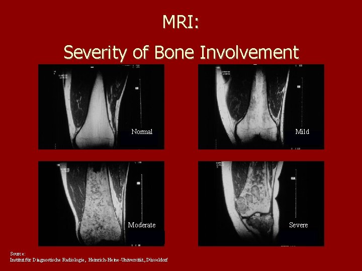 MRI: Severity of Bone Involvement Normal Moderate Source: Institut für Diagnostische Radiologie, Heinrich-Heine-Universität, Düsseldorf