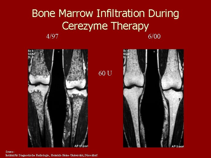 Bone Marrow Infiltration During Cerezyme Therapy 4/97 6/00 60 U Source: Institut für Diagnostische