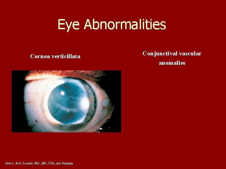 Eye Abnormalities Cornea verticillata Source: Prof. Desnick, Ph. D, MD, USA, and Genzyme Conjunctival