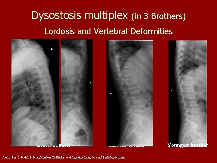 Dysostosis multiplex (in 3 Brothers) Lordosis and Vertebral Deformities Eldest brother Middle brother Source: