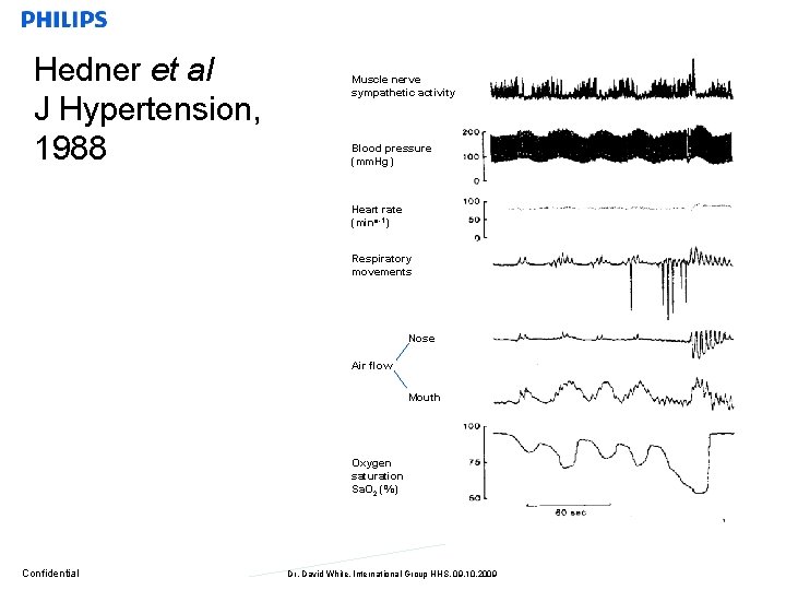 Hedner et al J Hypertension, 1988 Muscle nerve sympathetic activity Blood pressure (mm. Hg)