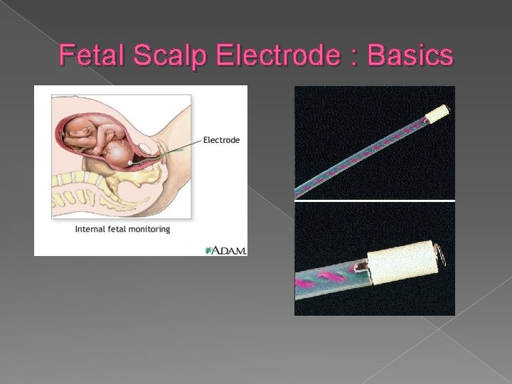 Fetal Scalp Electrode : Basics 