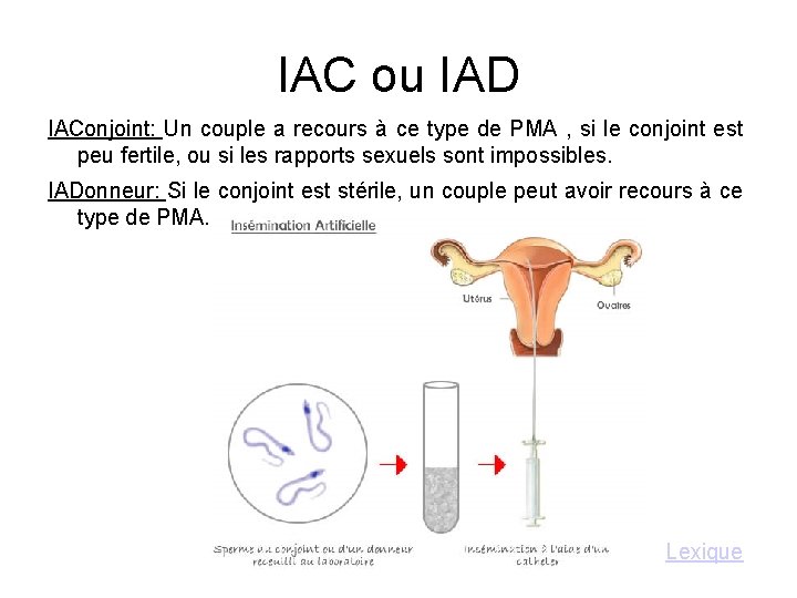 IAC ou IAD IAConjoint: Un couple a recours à ce type de PMA ,