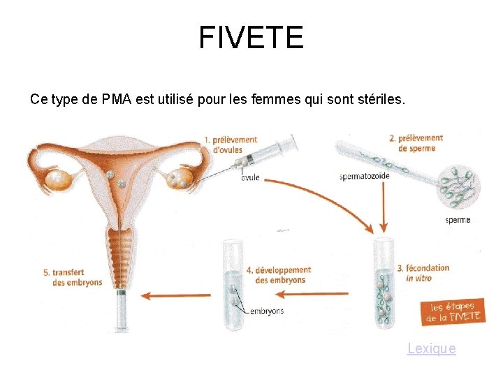 FIVETE Ce type de PMA est utilisé pour les femmes qui sont stériles. Lexique