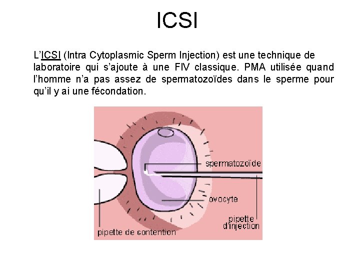 ICSI L’ICSI (Intra Cytoplasmic Sperm Injection) est une technique de laboratoire qui s’ajoute à