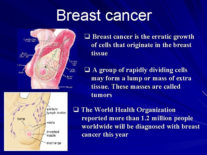 Breast cancer q Breast cancer is the erratic growth of cells that originate in