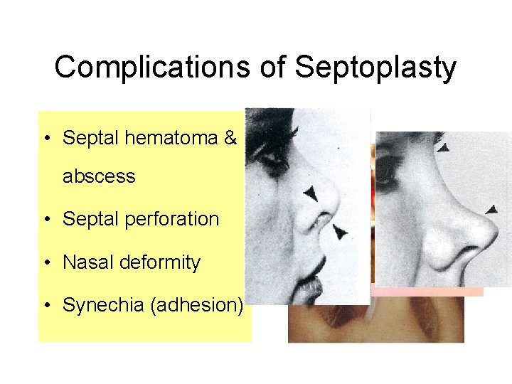 Complications of Septoplasty • Septal hematoma & abscess • Septal perforation • Nasal deformity