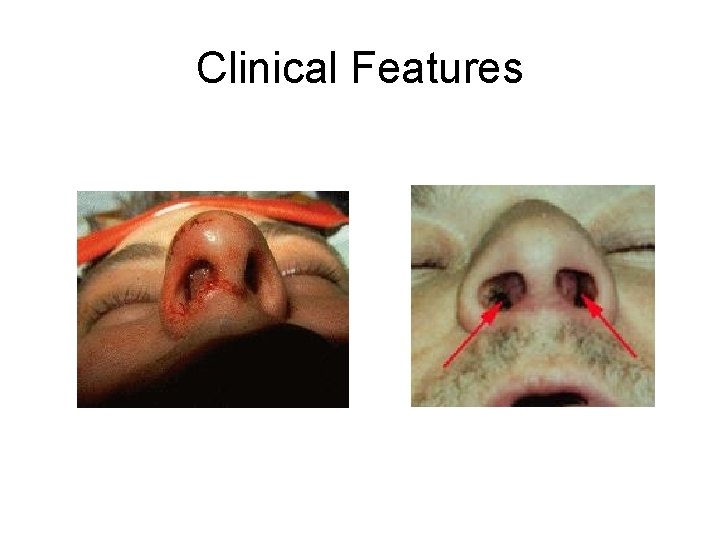 Clinical Features  Clinical Features