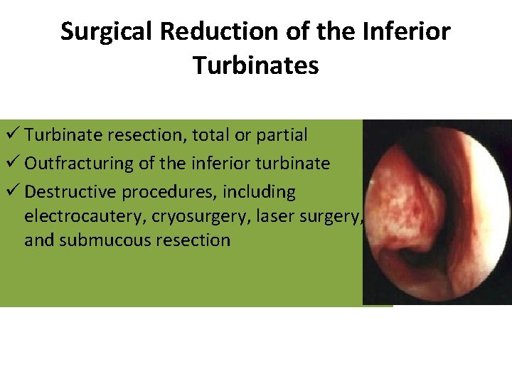 Surgical Reduction of the Inferior Turbinates ü Turbinate resection, total or partial ü Outfracturing Surgical Reduction of the Inferior Turbinates ü Turbinate resection, total or partial ü Outfracturing