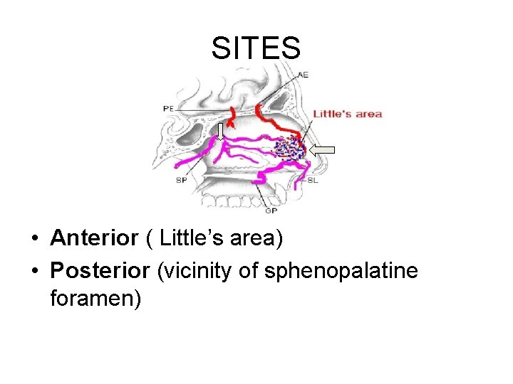 SITES • Anterior ( Little’s area) • Posterior (vicinity of sphenopalatine foramen) 