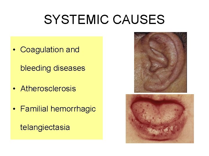 SYSTEMIC CAUSES • Coagulation and bleeding diseases • Atherosclerosis • Familial hemorrhagic telangiectasia  SYSTEMIC CAUSES • Coagulation and bleeding diseases • Atherosclerosis • Familial hemorrhagic telangiectasia